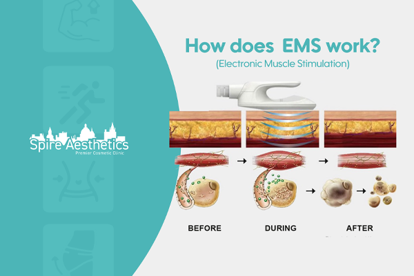 EMS treatment for post pregnancy weight loss treatment Warfield