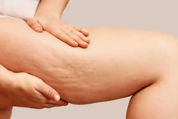 Image of woman showing leg with cellulite Warfield