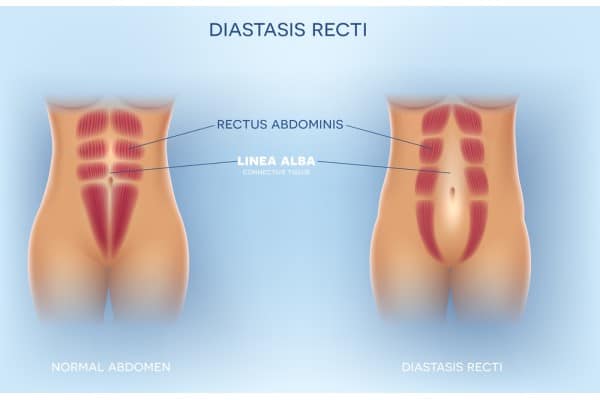 What Non-Surgical Options Are Available for Diastasis Recti Warfield?