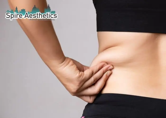 Image of woman pinching fat on their hips Warfield. Fat Freezing treatment