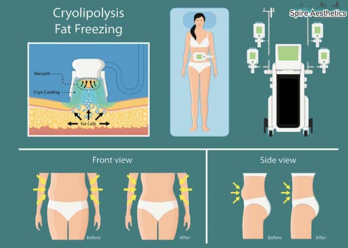 Image of diet and fat freezing combined for best results for Spire Aesthetics Warfield