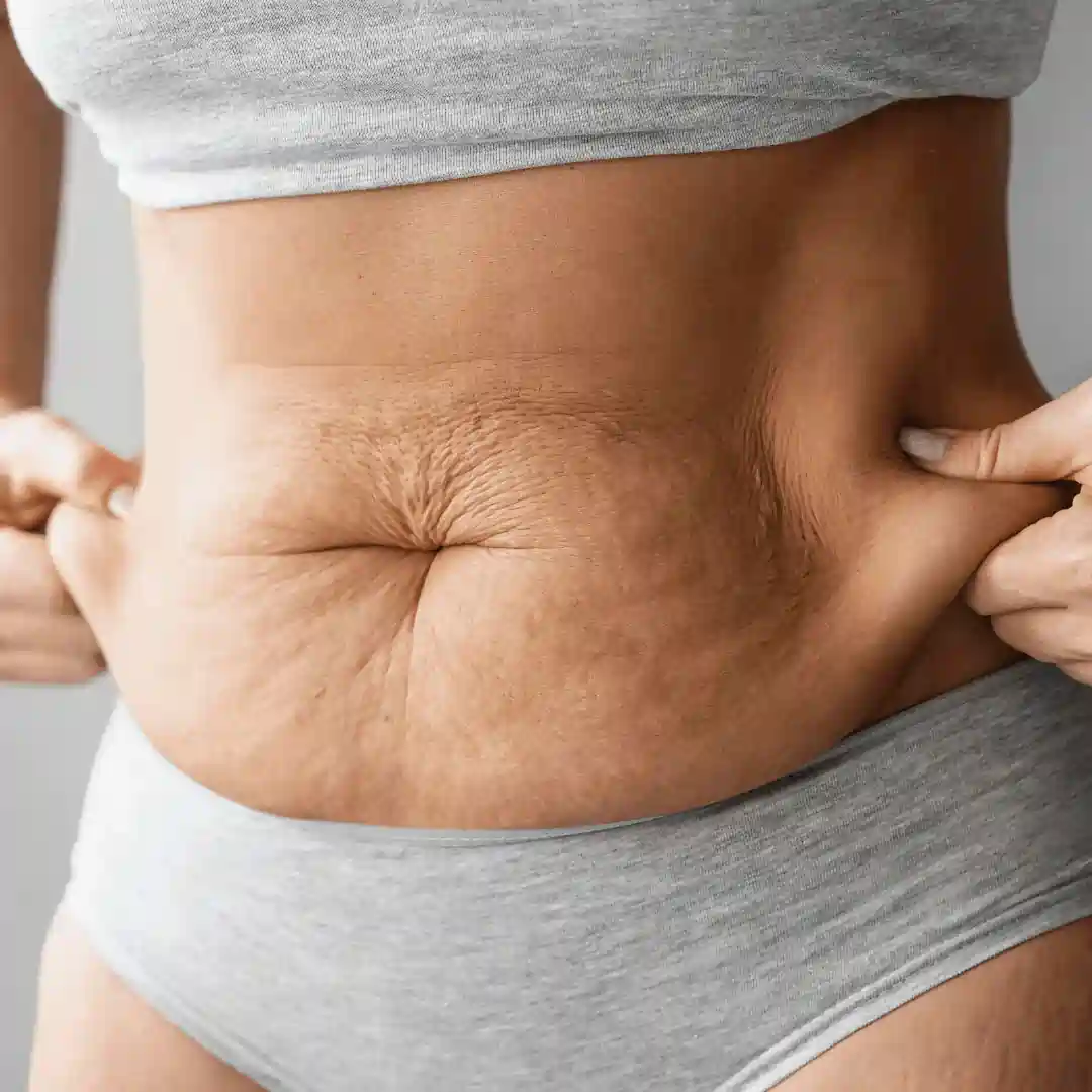 Is It Normal to Have Loose Skin After Pregnancy Warfield?