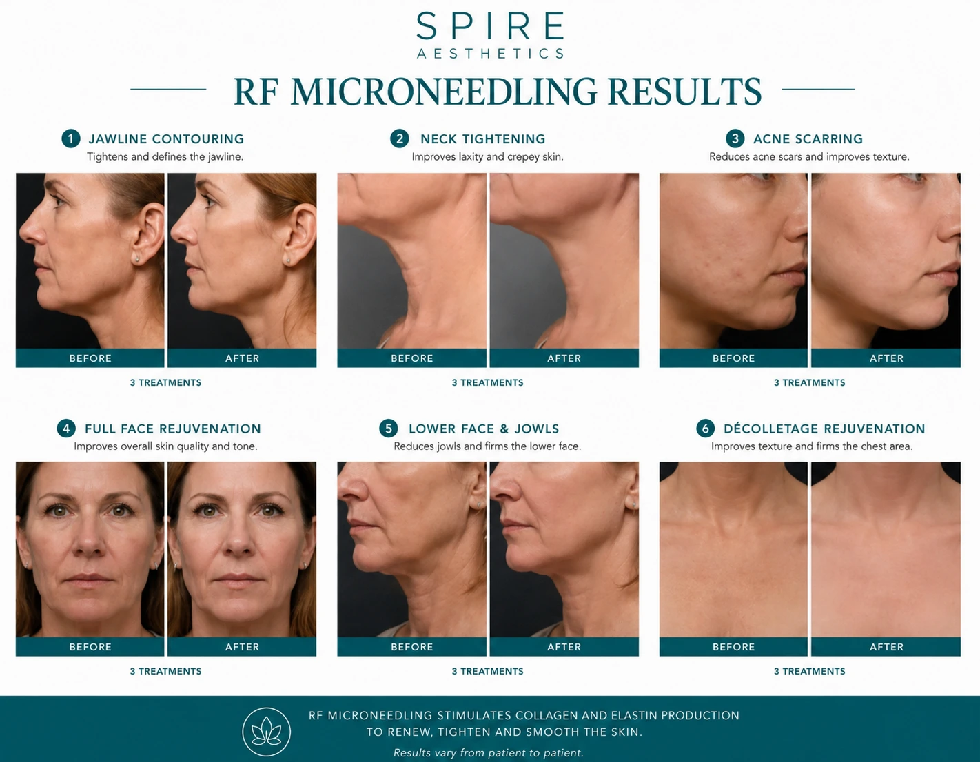 RF Microneedling Skin tightening Warfield results