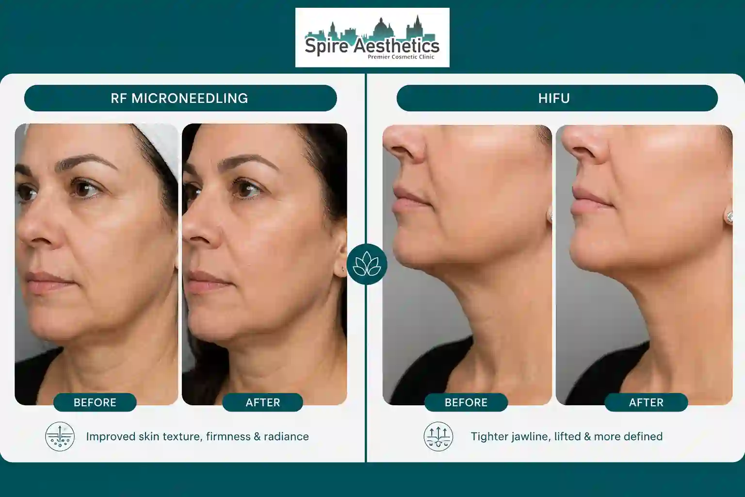 Can RF Microneedling and HIFU Be Combined Warfield?