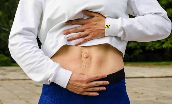 When Could Diastasis Recti Be the Missing Piece of the Puzzle Warfield?