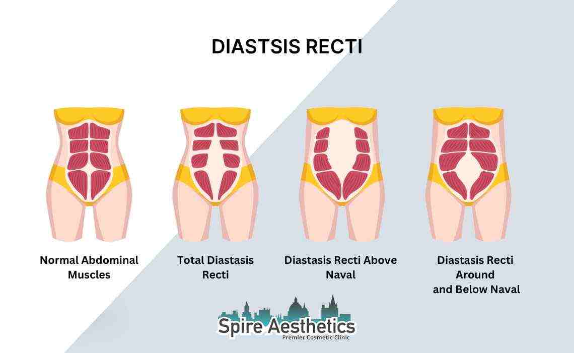 Is Non-Surgical Diastasis Recti Treatment Right for You? Common Concerns Answered Warfield